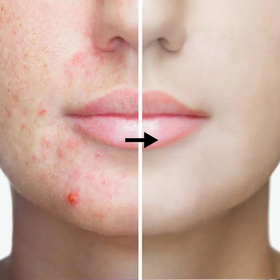Anti Acne